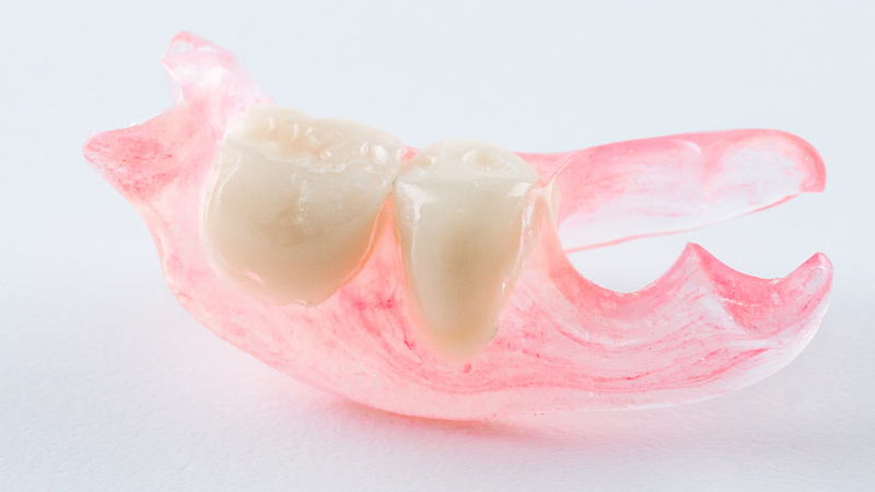 ノンクラスプデンチャー