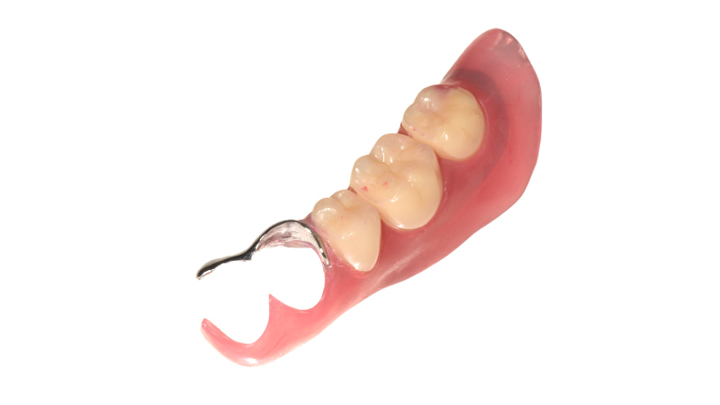 ノンクラスプデンチャー