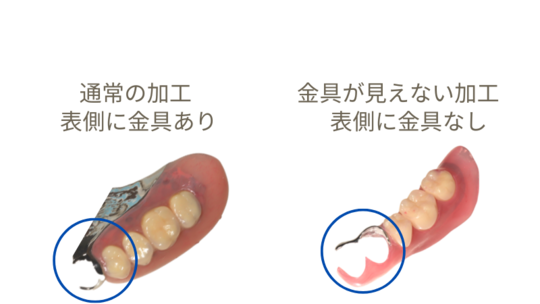 金属床義歯・入れ歯の値段とデメリット（チタン床とコバルトクロム）