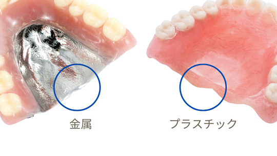 金属床義歯・入れ歯の値段とデメリット（チタン床とコバルトクロム）