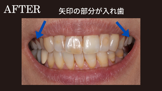 ノンクラスプデンチャー（コンティース）の部分入れ歯の症例「違和感