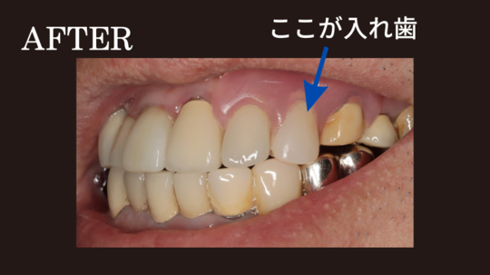 未使用 義歯・上の入れ歯① 目立ちにくい(ノンクラスプ義歯)入れ歯｜さかえ歯科クリニック 神奈川