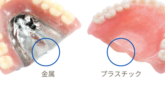 金属床義歯・入れ歯の値段とデメリット（チタン床とコバルトクロム）